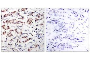 Immunohistochemical analysis of paraffin-embedded human breast carcinoma tissue using STAT5A (phospho-Tyr694) antibody (E011048). (STAT5A antibody  (pTyr694))
