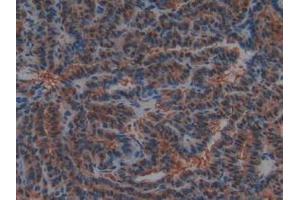 IHC-P analysis of Human Thyroid Cancer Tissue, with DAB staining. (PTF1A antibody  (AA 177-328))