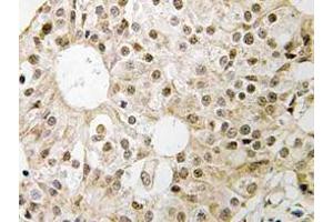 Immunohistochemistry (IHC) analyzes of CD3EAP antibody in paraffin-embedded human breast carcinoma tissue. (CD3EAP antibody)