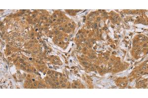 Immunohistochemistry of paraffin-embedded Human cervical cancer tissue using KCNJ15 Polyclonal Antibody at dilution 1:40 (KCNJ15 antibody)