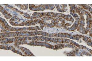 ABIN6267170 at 1/100 staining Human thyroid cancer tissue by IHC-P. (RICTOR antibody  (pThr1135))