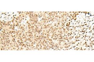 Immunohistochemistry of paraffin-embedded Human ovarian cancer tissue using FKBP5 Polyclonal Antibody at dilution of 1:50(x200) (FKBP5 antibody)