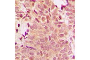 Immunohistochemical analysis of Histone Deacetylase 5 staining in human breast cancer formalin fixed paraffin embedded tissue section. (HDAC5 antibody  (Center))