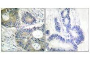 Immunohistochemical analysis of paraffin-embedded human colon carcinoma tissue using 4E-BP1 (Ab-64) antibody. (eIF4EBP1 antibody  (Ser65))