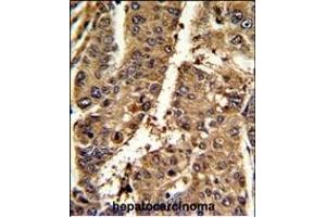 Formalin-fixed and paraffin-embedded mouse hepatocarcinoma reacted with PSME2 Antibody (C-term), which was peroxidase-conjugated to the secondary antibody, followed by DAB staining. (PSME2 antibody  (C-Term))