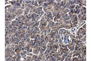 IHC-P Image LYRIC antibody [N2C3] detects LYRIC protein at cytosol on human breast carcinoma by immunohistochemical analysis. (MTDH antibody)