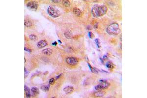 Immunohistochemical analysis of Cytochrome P450 2J2 staining in human liver cancer formalin fixed paraffin embedded tissue section. (CYP2J2 antibody  (Center))