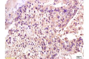 Formalin-fixed and paraffin embedded human lung carcinoma labeled with Anti-S100A10 Polyclonal Antibody, Unconjugated (ABIN1386030) at 1:200 followed by conjugation to the secondary antibody and DAB staining. (S100A10 antibody  (AA 21-97))