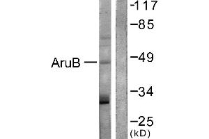 Immunohistochemistry analysis of paraffin-embedded human liver carcinoma tissue using AurB (Ab-12) antibody. (Aurora Kinase B antibody)