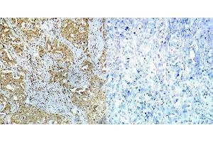 Immunohistochemical analysis of paraffin-embedded human breast carcinoma tissue using Abl1 (phospho- Tyr412) antibody (E012002). (ABL1 antibody  (pTyr412))