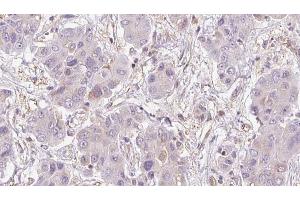 ABIN6273951 at 1/100 staining Human liver cancer tissue by IHC-P. (NMUR2 antibody  (C-Term))