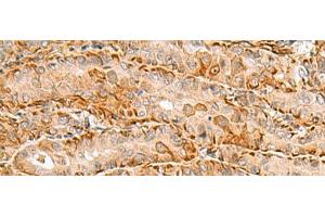 Immunohistochemistry of paraffin-embedded Human thyroid cancer tissue using C3orf38 Polyclonal Antibody at dilution of 1:80(x200) (C3orf38 antibody)