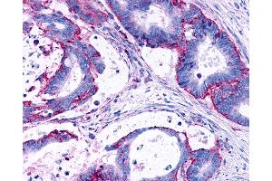 Anti-LPAR3 / LPA3 / EDG7 antibody IHC of human Colon, Carcinoma. (LPAR3 antibody  (Cytoplasmic Domain))