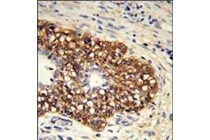 Formalin-fixed and paraffin-embedded human prostate carcinoma reacted with CYP8A1 Antibody (C-term) (ABIN652421 and ABIN2842087) , which was peroxidase-conjugated to the secondary antibody, followed by DAB staining. (PTGIS antibody  (C-Term))
