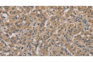 Immunohistochemistry of paraffin-embedded Human thyroid cancer tissue using AGTRAP Polyclonal Antibody at dilution 1:40 (AGTRAP antibody)