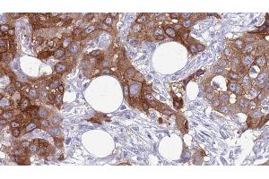 ABIN6272640 at 1/100 staining Human Head and neck cancer tissue by IHC-P. (COLEC12 antibody  (C-Term))
