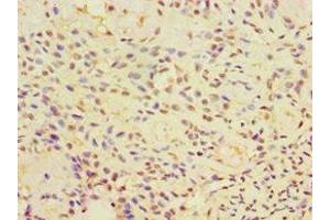 Immunohistochemistry of paraffin-embedded human breast cancer using ABIN7146575 at dilution of 1:100 (Calreticulin 3 antibody  (AA 135-384))