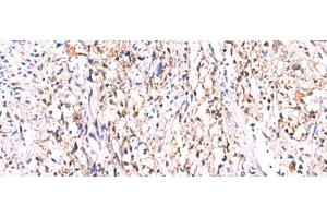 Immunohistochemistry of paraffin-embedded Human cervical cancer tissue using GMDS Polyclonal Antibody at dilution of 1:70(x200) (GMDS antibody)
