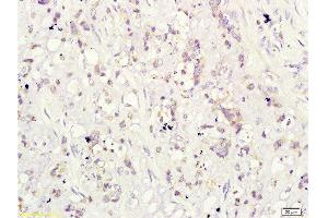Formalin-fixed and paraffin-embedded human cervical carcinoma labeled with Rabbit Anti-CD160/By55 Polyclonal Antibody ( , Unconjugated at 1:200 followed by conjugation to the secondary antibody and DAB staining
