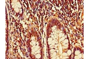 Immunohistochemistry of paraffin-embedded human colon cancer using ABIN7149691 at dilution of 1:100 (CDT2/RAMP antibody  (AA 393-550))