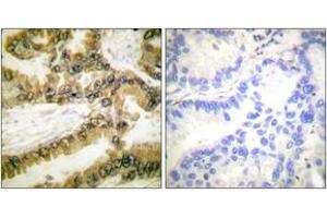 Immunohistochemistry analysis of paraffin-embedded human lung carcinoma, using Akt1 (Phospho-Thr450) Antibody. (AKT1 antibody  (pThr450))