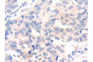 DAB staining on IHC-P; Samples: Human Breast cancer Tissue (IL-7 antibody  (AA 26-177))