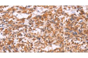 Immunohistochemistry of paraffin-embedded Human thyroid cancer tissue using EMP2 Polyclonal Antibody at dilution 1:30 (EMP2 antibody)