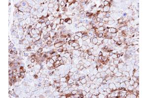 IHC-P Image Immunohistochemical analysis of paraffin-embedded CL1-0 xenograft, using GPR86, antibody at 1:500 dilution. (Purinergic Receptor P2Y, G-Protein Coupled, 13 (P2RY13) (Internal Region) antibody)