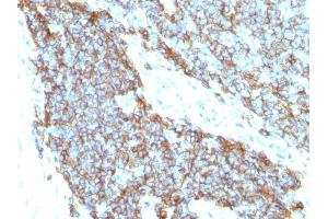 Formalin-fixed, paraffin-embedded human Ewing's sarcoma stained with CD99 Monoclonal Antibody (12E7+MIC2/877). (CD99 antibody)