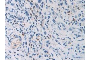 Detection of CEACAM7 in Human Stomach cancer Tissue using Polyclonal Antibody to Carcinoembryonic Antigen Related Cell Adhesion Molecule 7 (CEACAM7) (CEACAM7 antibody  (AA 147-231))