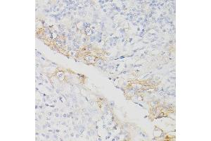 Immunohistochemistry of paraffin-embedded Human chronic tonsillitis using PD-L1/CD274/CD274 Rabbit mAb (ABIN7266181) at dilution of 1:200 (40x lens). (PD-L1 antibody  (Extracellular Domain))
