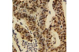 Immunohistochemical staining of human rectal cancer tissue with TNFAIP1 polyclonal antibody .