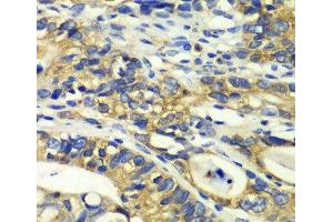 Immunohistochemistry of paraffin-embedded Human colon carcinoma using RPH3A Polyclonal Antibody at dilution of 1:100 (40x lens). (RPH3A antibody)