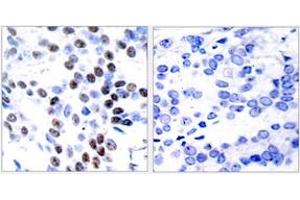 Immunohistochemistry analysis of paraffin-embedded human breast carcinoma tissue, using c-Jun (Ab-93) Antibody. (C-JUN antibody  (AA 61-110))