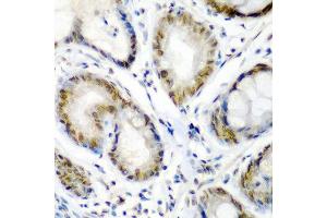 Immunohistochemistry of paraffin-embedded human colon carcinoma using SS18 antibody at dilution of 1:200 (40x lens).