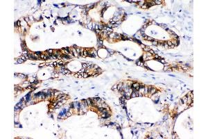 Anti-NKCC1 antibody, IHC(P) IHC(P): Human Intestinal Cancer Tissue (SLC12A2 antibody  (N-Term))