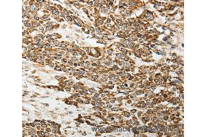 Immunohistochemistry of Human lung cancer using SELE Polyclonal Antibody at dilution of 1:30 (Selectin E/CD62e antibody)