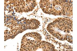 The image on the left is immunohistochemistry of paraffin-embedded Human colon cancer tissue using ABIN7192626(SPATA20 Antibody) at dilution 1/70, on the right is treated with synthetic peptide. (SPATA2 antibody)