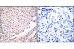 Immunohistochemistry analysis of paraffin-embedded human lung carcinoma tissue, using Cullin 1 Antibody. (Cullin 1 antibody  (AA 727-776))