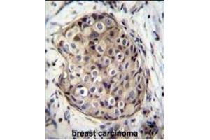 GR Antibody (C-term) (ABIN656814 and ABIN2846028) immunohistochemistry analysis in formalin fixed and paraffin embedded human breast carcinoma followed by peroxidase conjugation of the secondary antibody and DAB staining. (GMPR antibody  (C-Term))