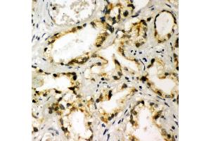 Anti-NAK antibody, IHC(P) IHC(P): Human Prostatic Cancer Tissue