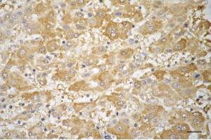 Immunohistochemistry was performed on paraffin-embedded human hepatocarcinoma using TRIM7 antibody (ABIN7800643), 1:200). (TRIM7 antibody)