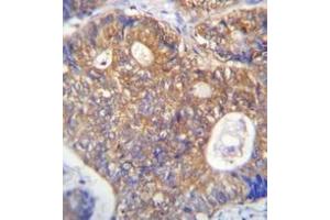 Immunohistochemistry analysis in formalin fixed and paraffin embedded human colon carcinoma reacted with PAICS Antibody (N-term) followed which was peroxidase conjugated to the secondary antibody and followed by DAB staining. (PAICS antibody  (N-Term))