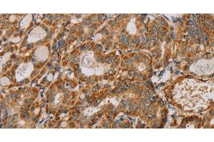 Immunohistochemistry of paraffin-embedded Human thyroid cancer using MTFR1 Polyclonal Antibody at dilution of 1:40