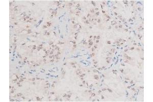 ABIN6267577 at 1/200 staining Human lung cancer tissue sections by IHC-P. (XIAP antibody  (pSer87))