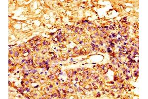 IHC image of ABIN7159428 diluted at 1:300 and staining in paraffin-embedded human ovarian cancer performed on a Leica BondTM system. (Mesothelin antibody  (AA 37-598))