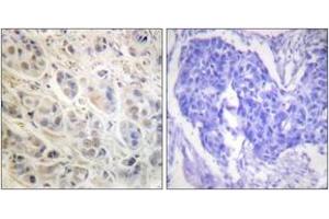 Immunohistochemistry analysis of paraffin-embedded human breast carcinoma tissue, using p90 RSK (Ab-573) Antibody. (RPS6KA3 antibody  (AA 539-588))