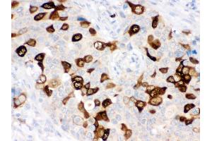 Anti- RRM2 Picoband antibody, IHC(P) IHC(P): Human Mammary Cancer Tissue (RRM2 antibody  (N-Term))