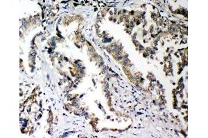 IHC-P: PLK2 antibody testing of human lung cancer tissue (PLK2 antibody  (C-Term))