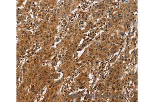Immunohistochemistry of Human liver cancer using ATF4 Polyclonal Antibody at dilution of 1:50 (ATF4 antibody)